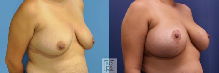 Before & After Breast Lift Case 353 View #5 View in Torrance, CA