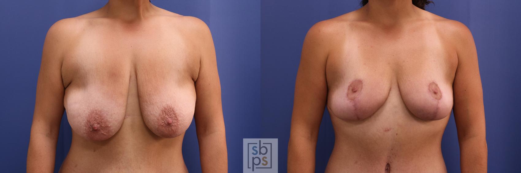 Before & After Breast Lift Case 382 View #1 View in Torrance, CA