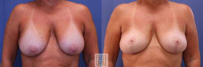 Before & After Breast Lift Case 418 Front View in Torrance, CA
