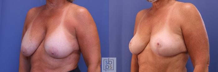 Before & After Breast Lift Case 418 Left Oblique View in Torrance, CA