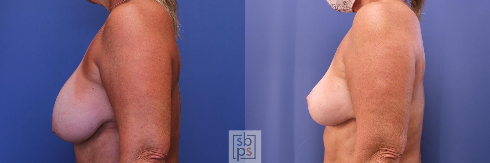Before & After Breast Augmentation Case 418 Left Side View in Torrance & Los Angeles, CA, CA