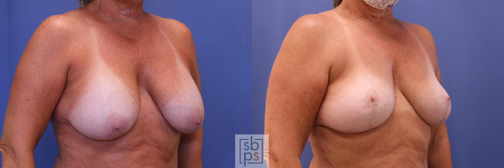 Before & After Breast Augmentation Case 418 Right Oblique View in Torrance & Los Angeles, CA, CA