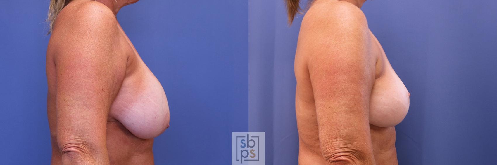 Before & After Breast Augmentation Case 418 Right Side View in Torrance & Los Angeles, CA, CA