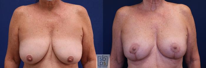 Before & After Breast Lift Case 513 Front View in Torrance, CA