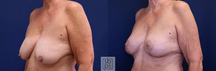 Before & After Breast Lift Case 513 Left Oblique View in Torrance, CA