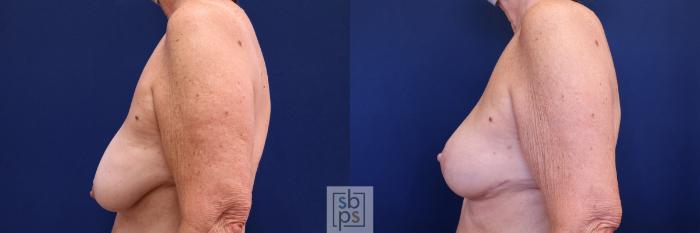 Before & After Breast Lift Case 513 Left Side View in Torrance, CA