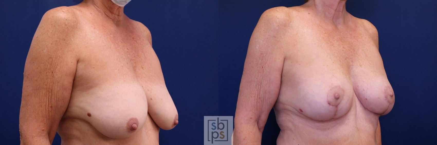 Before & After Breast Lift Case 513 Right Oblique View in Torrance & Los Angeles, CA, CA