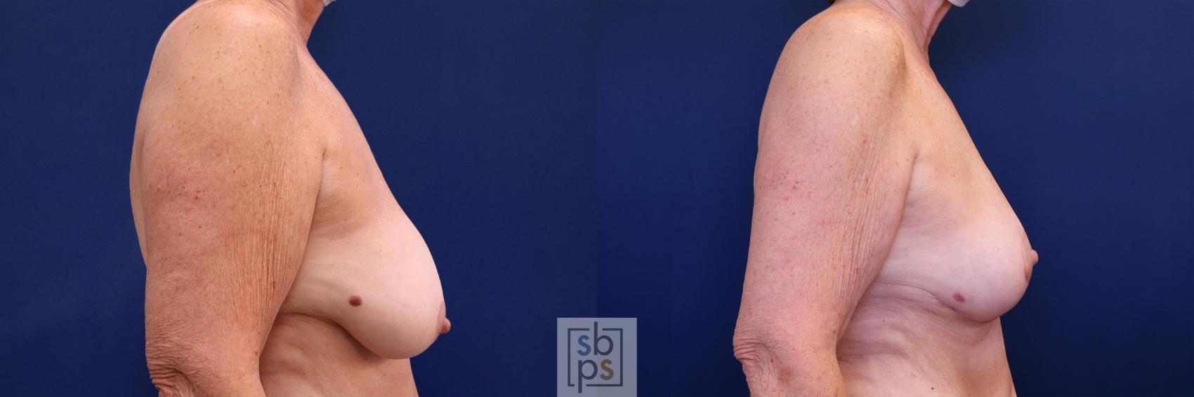 Before & After Breast Lift Case 513 Right Side View in Torrance & Los Angeles, CA, CA