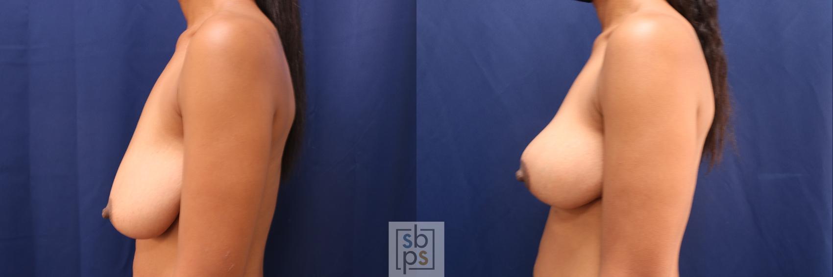 Before & After Breast Lift Case 545 Left Side View in Torrance & Los Angeles, CA, CA