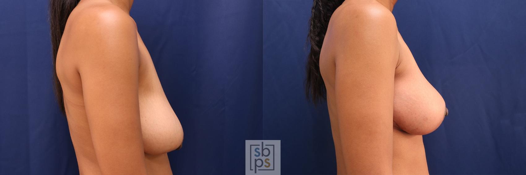 Before & After Breast Lift Case 545 Right Side View in Torrance & Los Angeles, CA, CA