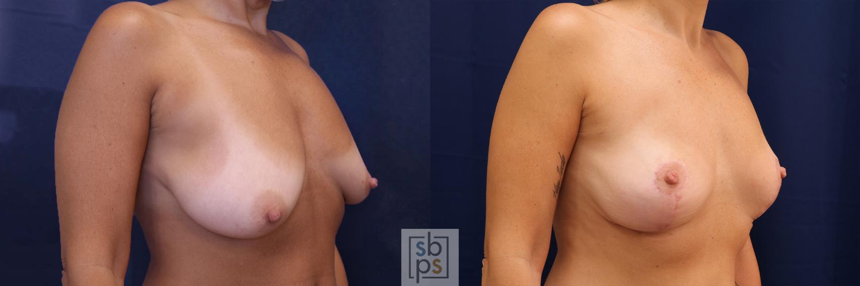 Before & After Liposuction Case 578 Left Oblique View in Torrance & Los Angeles, CA, CA