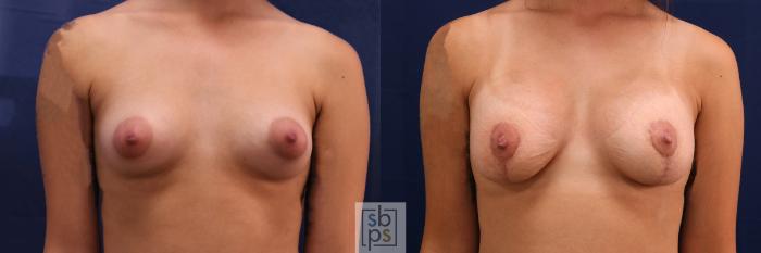Before & After Breast Augmentation Case 611 Front View in Torrance, CA