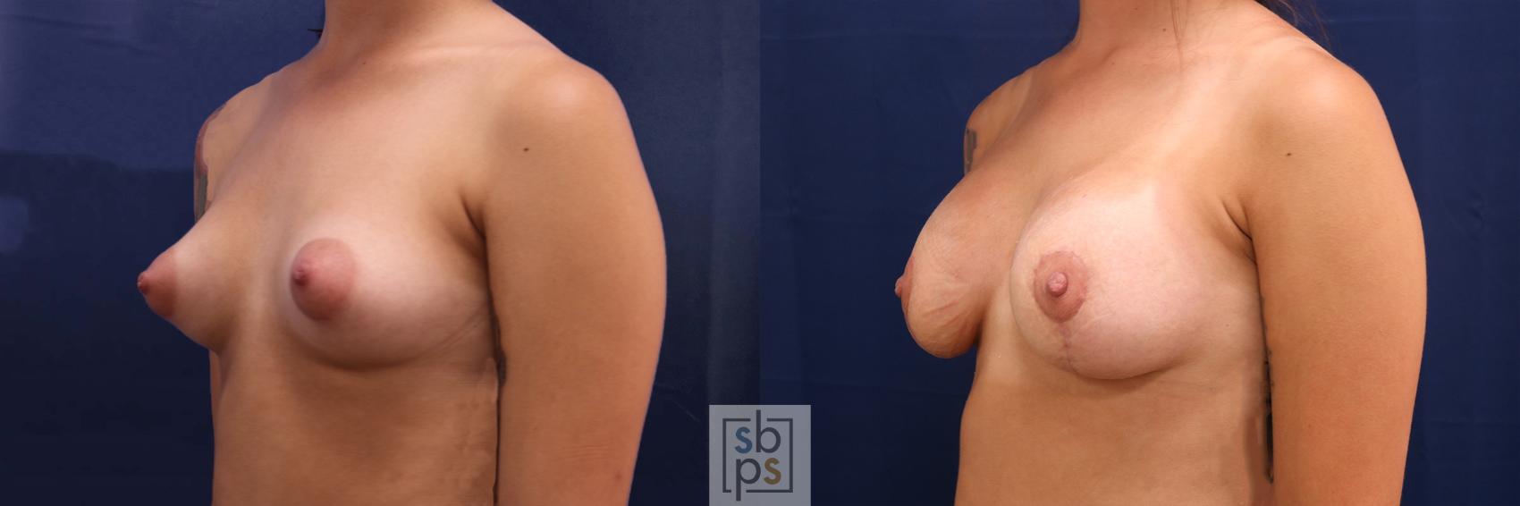 Before & After Breast Augmentation Case 611 Left Oblique View in Torrance & Los Angeles, CA, CA