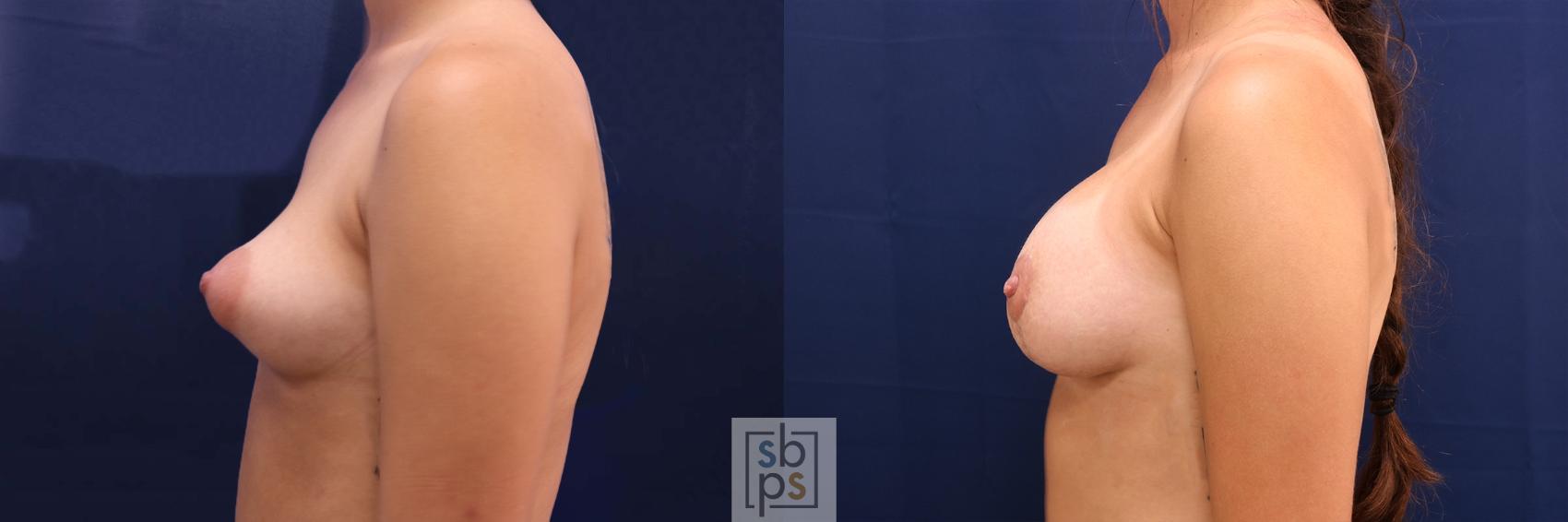 Before & After Breast Augmentation Case 611 Left Side View in Torrance & Los Angeles, CA, CA