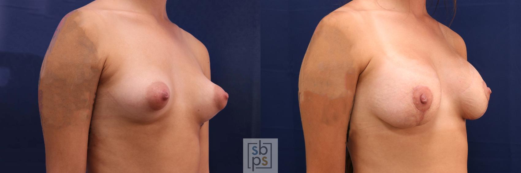 Before & After Breast Augmentation Case 611 Right Oblique View in Torrance & Los Angeles, CA, CA