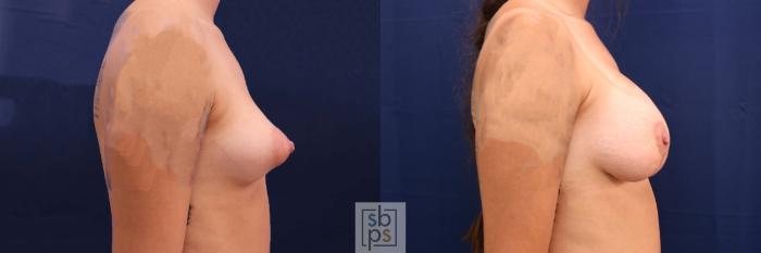 Before & After Breast Lift Case 611 Right Side View in Torrance, CA