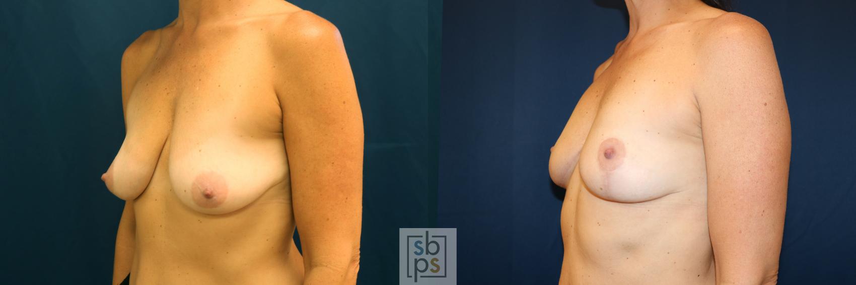 Before & After Breast Lift Case 628 Left Oblique View in Los Angeles, Torrance & Long Beach, CA