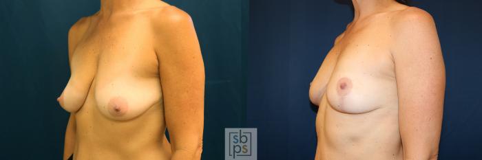 Before & After Breast Lift Case 628 Left Oblique View in Torrance, CA