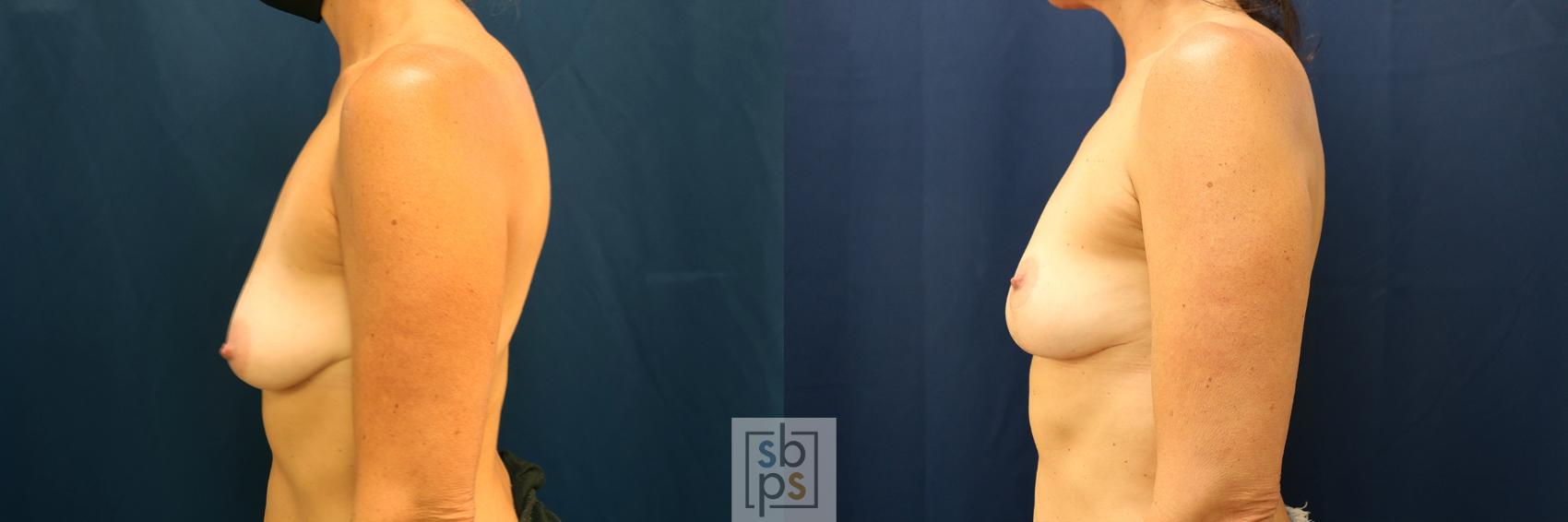 Before & After Breast Lift Case 628 Left Side View in Los Angeles, Torrance & Long Beach, CA