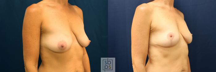 Before & After Breast Lift Case 628 Right Oblique View in Torrance, CA