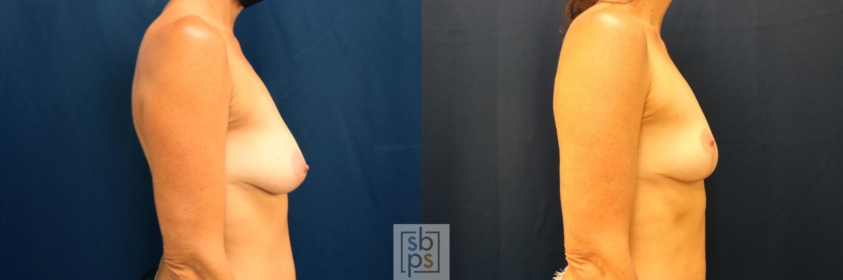 Before & After Breast Lift Case 628 Right Side View in Los Angeles, Torrance & Long Beach, CA