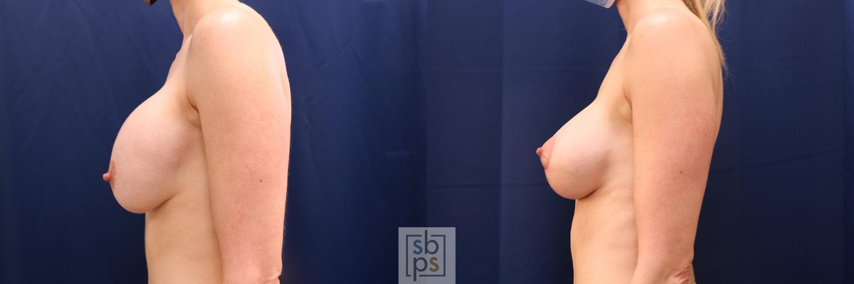 Before & After Breast Lift Case 638 Left Side View in Torrance & Los Angeles, CA, CA