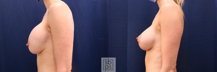 Before & After Breast Lift Case 638 Left Side View in Torrance, CA