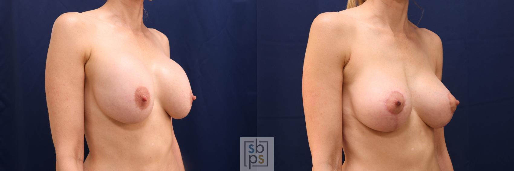 Before & After Breast Lift Case 638 Right Oblique View in Torrance & Los Angeles, CA, CA