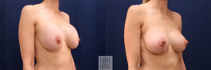 Before & After Breast Lift Case 638 Right Oblique View in Torrance, CA