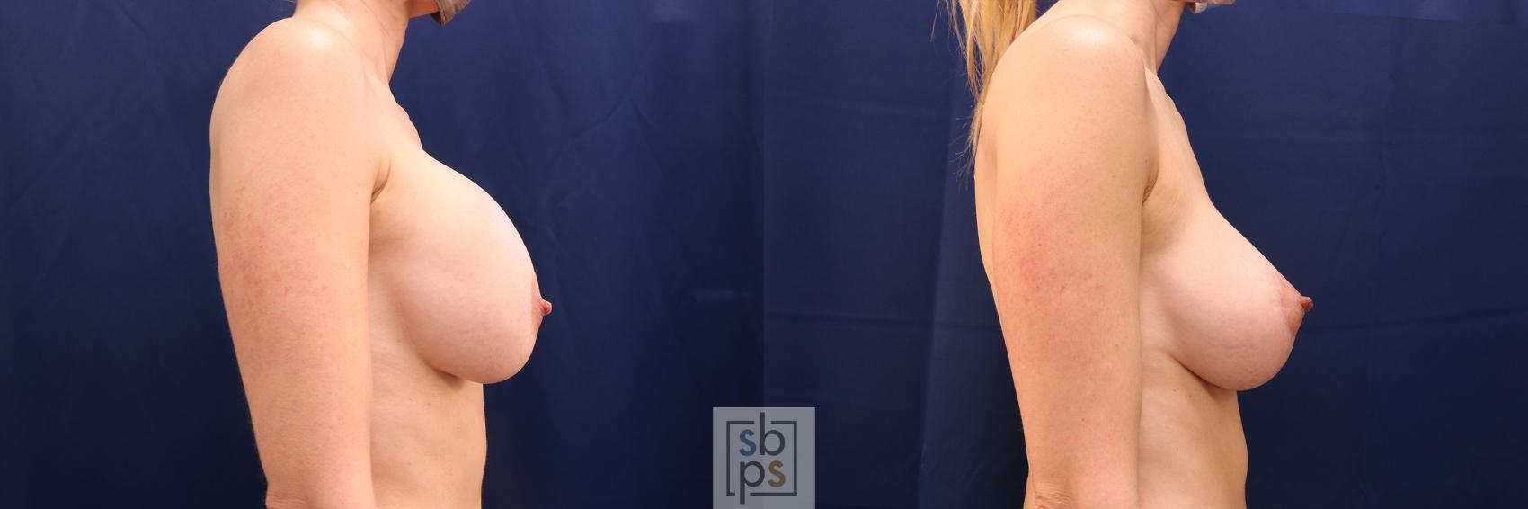 Before & After Breast Lift Case 638 Right Side View in Torrance & Los Angeles, CA, CA