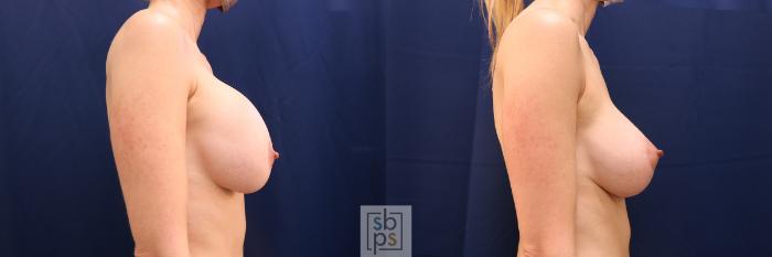 Before & After Breast Lift Case 638 Right Side View in Torrance, CA