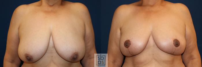 Before & After Breast Lift Case 685 Front View in Torrance, CA