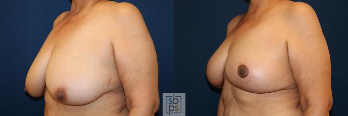 Before & After Breast Lift Case 685 Left Oblique View in Torrance, CA