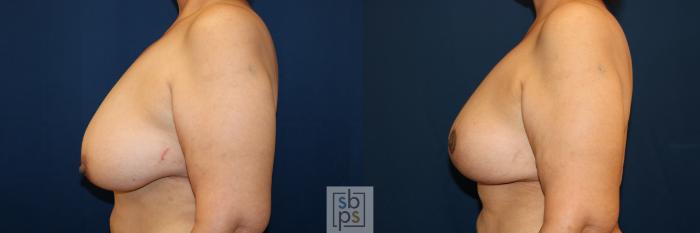 Before & After Breast Lift Case 685 Left Side View in Torrance, CA