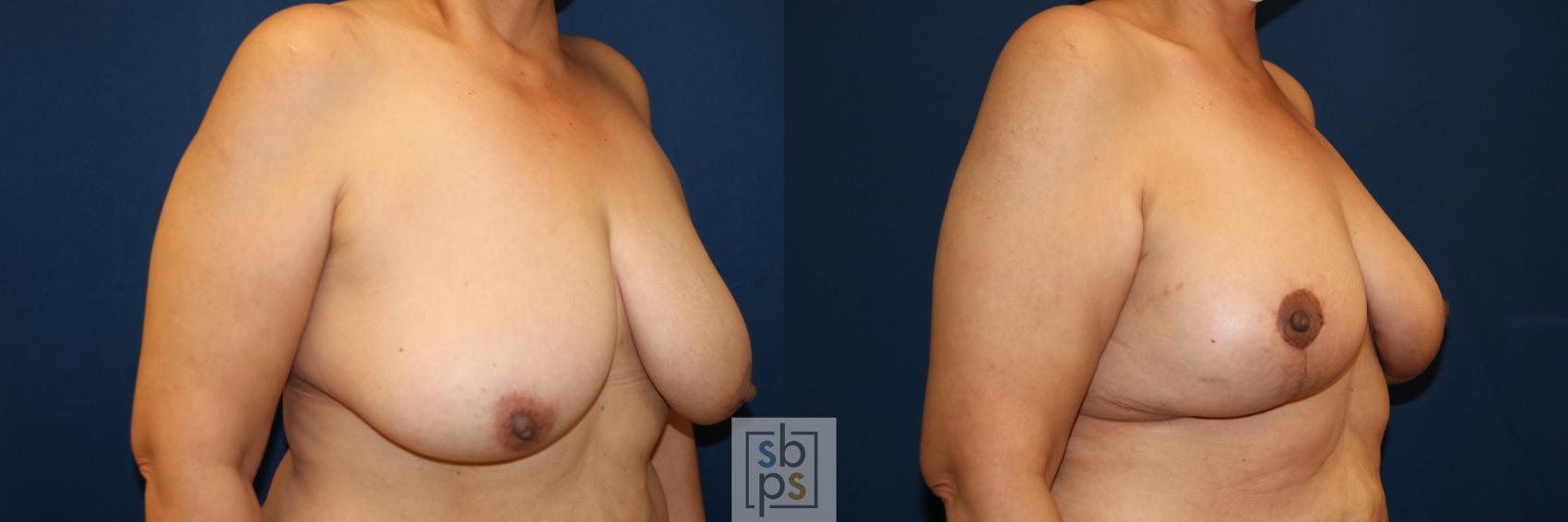 Before & After Breast Lift Case 685 Right Oblique View in Torrance & Los Angeles, CA, CA