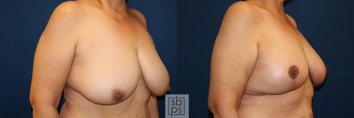 Before & After Breast Lift Case 685 Right Oblique View in Torrance, CA
