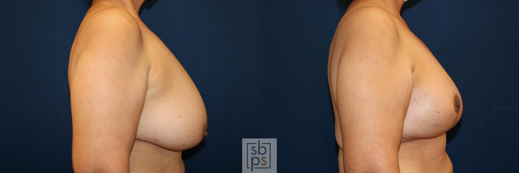 Before & After Breast Lift Case 685 Right Side View in Torrance & Los Angeles, CA, CA