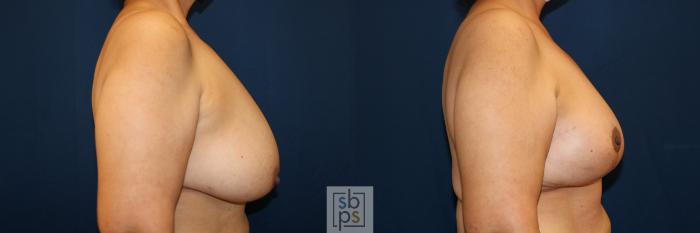 Before & After Breast Lift Case 685 Right Side View in Torrance, CA