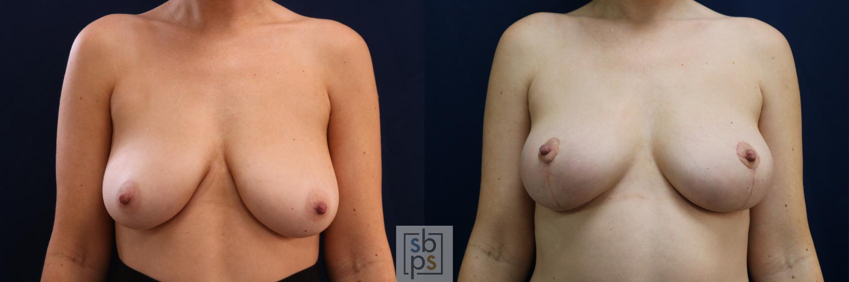 Before & After Breast Lift Case 695 Front View in Los Angeles & Torrance, CA, CA