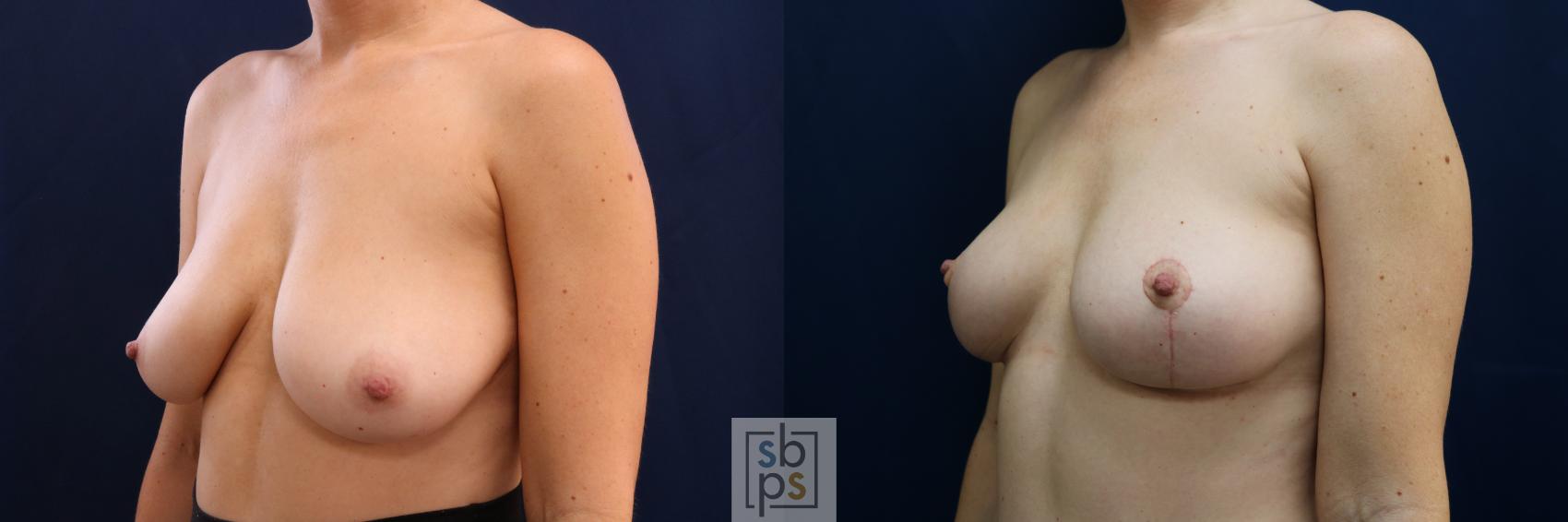 Before & After Breast Lift Case 695 Left Oblique View in Torrance & Los Angeles, CA, CA