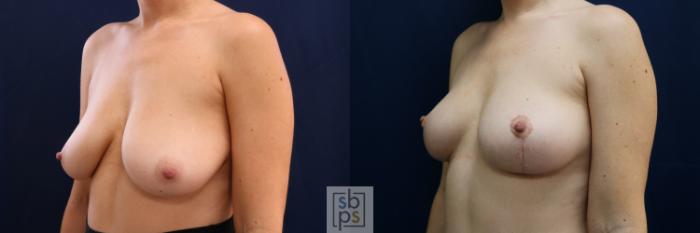 Before & After Breast Lift Case 695 Left Oblique View in Los Angeles & Torrance, CA, CA