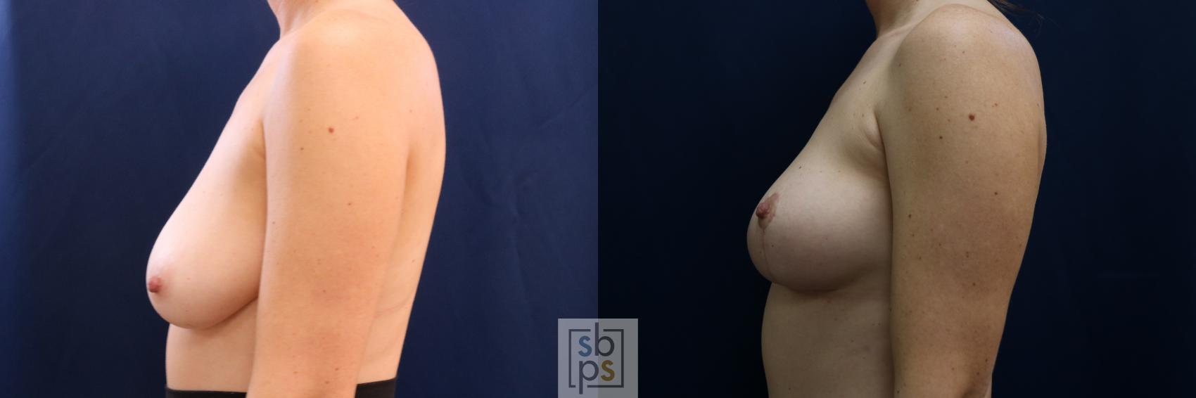 Before & After Breast Lift Case 695 Left Side View in Torrance & Los Angeles, CA, CA