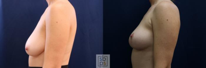 Before & After Breast Lift Case 695 Left Side View in Los Angeles & Torrance, CA, CA