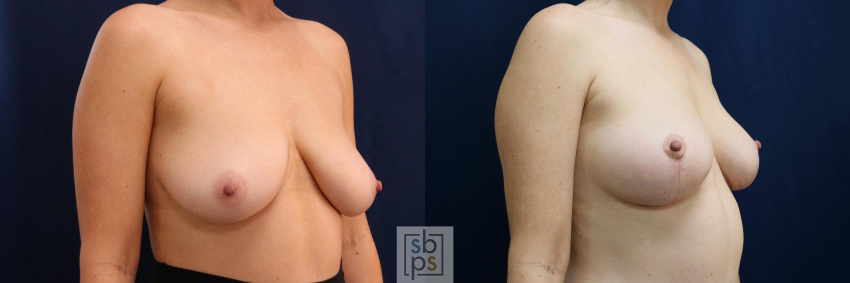 Before & After Breast Lift Case 695 Right Oblique View in Torrance & Los Angeles, CA, CA