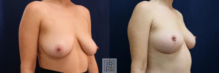 Before & After Breast Lift Case 695 Right Oblique View in Los Angeles & Torrance, CA, CA