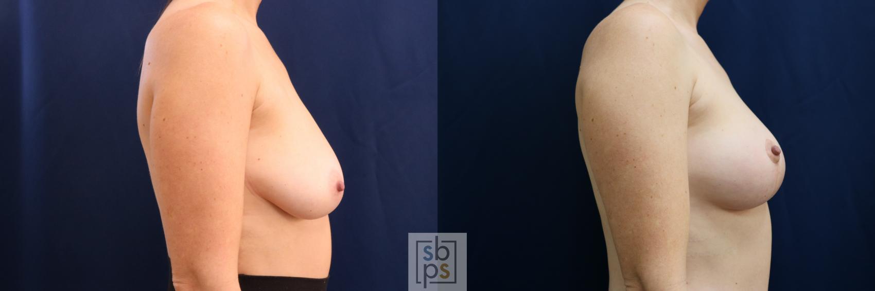 Before & After Breast Lift Case 695 Right Side View in Torrance & Los Angeles, CA, CA