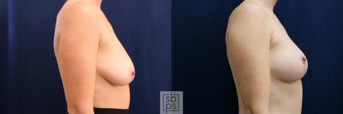 Before & After Breast Lift Case 695 Right Side View in Los Angeles & Torrance, CA, CA