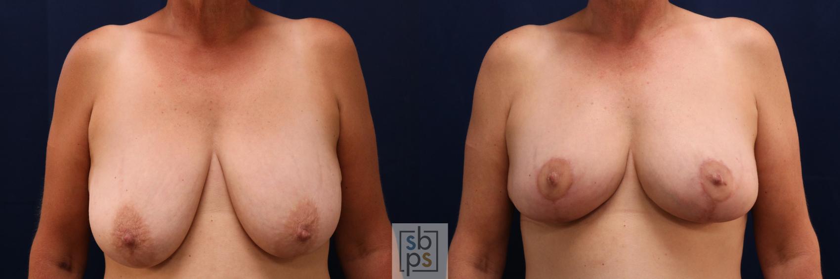 Before & After Breast Lift Case 722 Front View in Los Angeles & Torrance, CA, CA