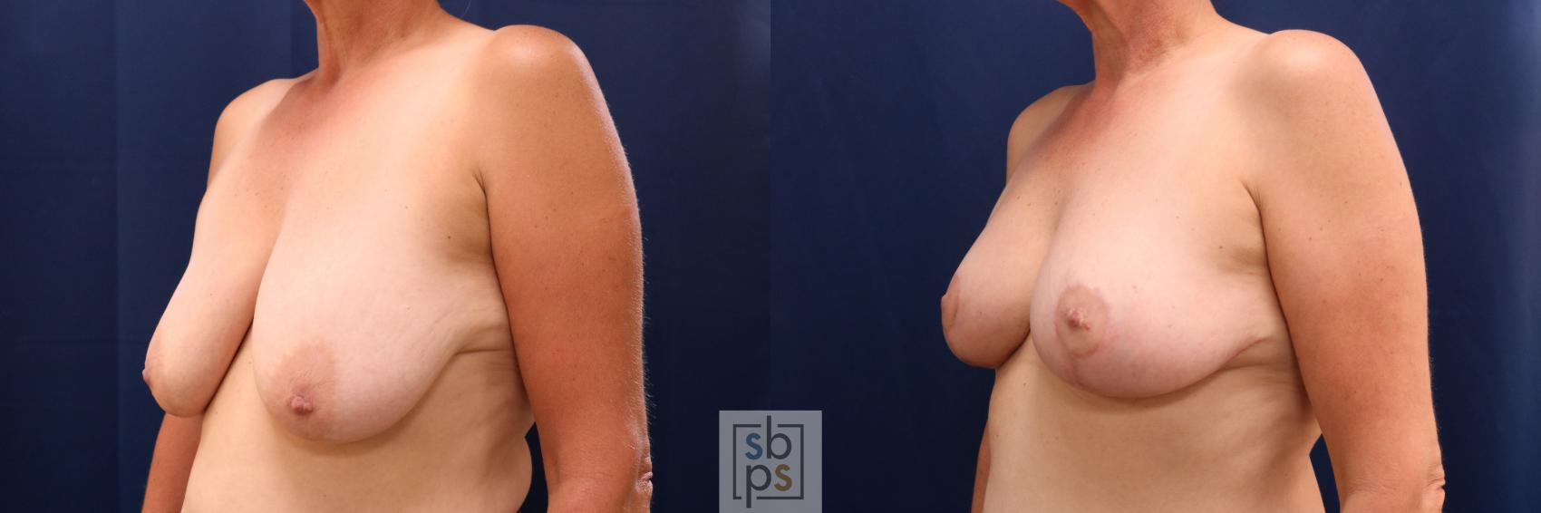 Before & After Breast Lift Case 722 Left Oblique View in Torrance & Los Angeles, CA, CA