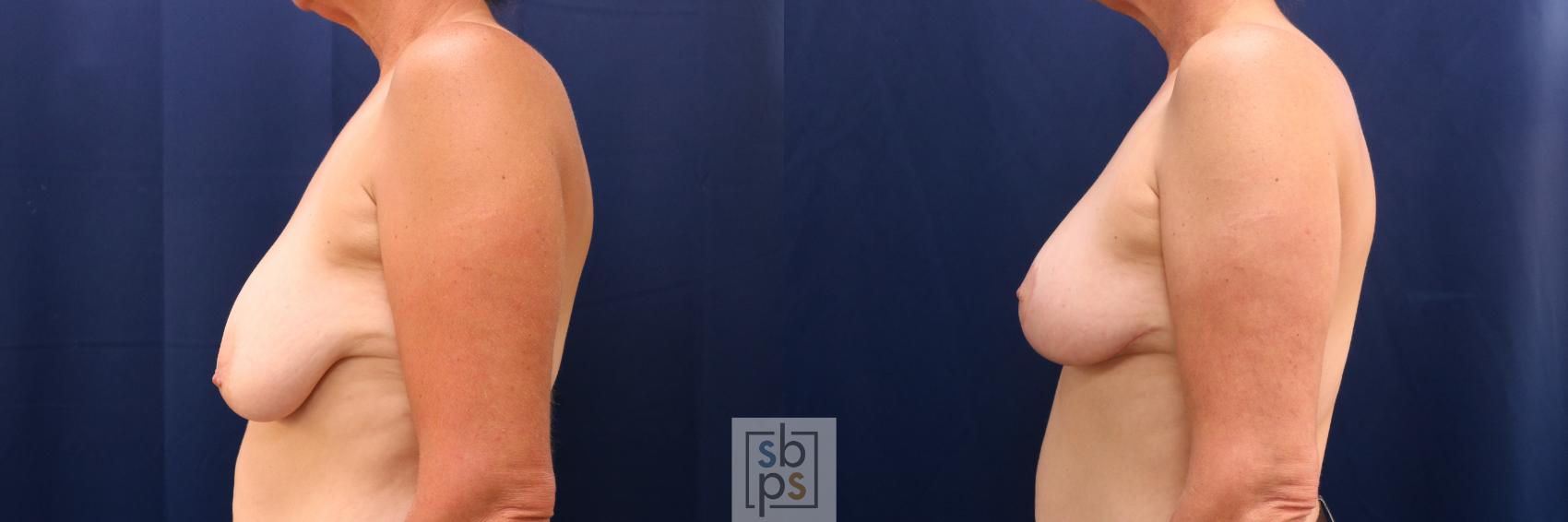 Before & After Breast Lift Case 722 Left Side View in Torrance & Los Angeles, CA, CA